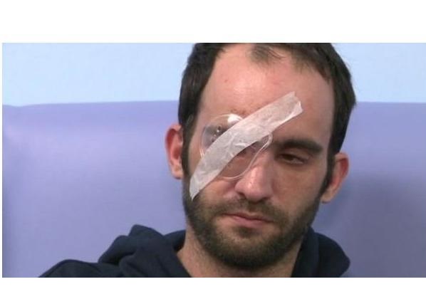 إصابة رجل بالعمى الدائم في إحدى عينيه بعد أن ألقى شاب بيضة عليه بإنجلترا